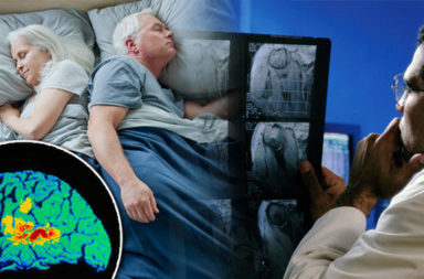 دراسة تؤكد العلاقة بين انقطاع التنفس في أثناء النوم وداء ألزهايمر - علامات تلف الدماغ - أدمغة المصابين بانقطاع التنفس الانسدادي خلال النوم - داء ألزهايمر