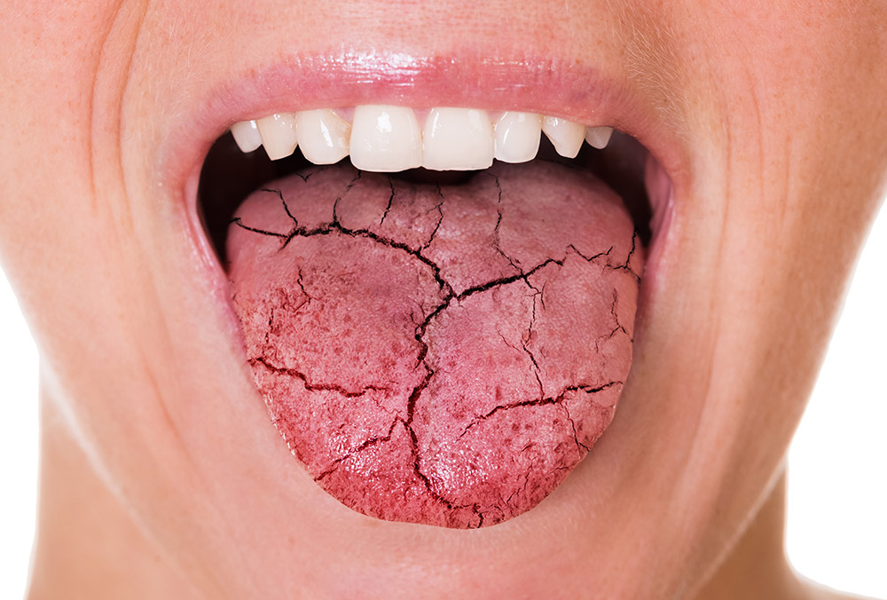 جفاف الفم: الأسباب والأعراض والعلاج
