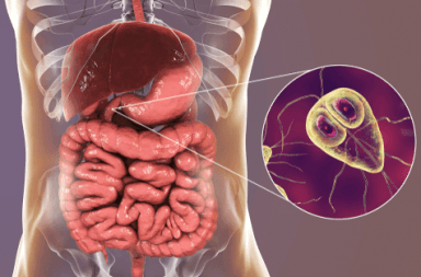 عدوى الجيارديا (الجيارديات) الأسباب والأعراض والتشخيص والعلاج علاج عدوى الجيارديا الطعام الملوث الماء غير النظيف الطفيليات