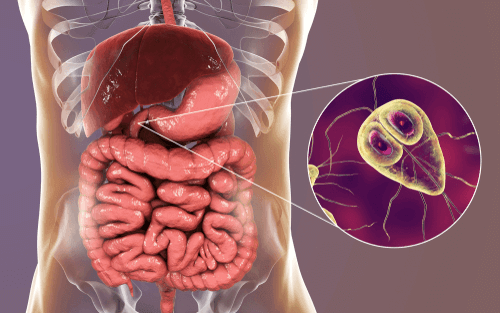 عدوى الجيارديا (الجيارديات): الأسباب والأعراض والتشخيص والعلاج