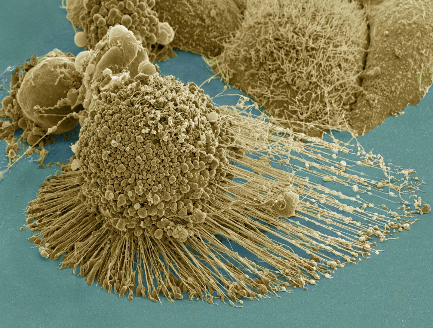 خلايا هيلا: ما علاقتها بسرطان عنق الرحم؟ وكيف ساعدت في تطور أبحاث السرطان؟