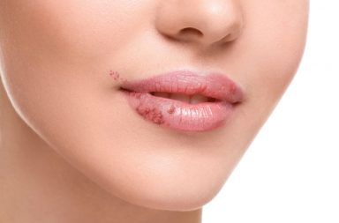 أسباب التهاب الشفة الزاوي ما الذي يسبب التهاب الفم الشفوي علاج التهابات الفم بقع حمراء على جانب الشفاه علاج تقرحات الشفاه