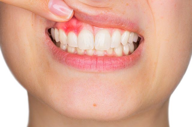ما الذي يسبب تورم اللثة حول السن - تورم اللثة وانتفاخها حول إحدى الأسنان أو أكثر - قلة الاهتمام بنظافة الفم - نزيف اللثة عن تنظيفها بالفرشاة