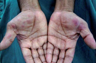 الحمامى المرتفعة الدائمة الأسباب والاعراض والتشخيص والعلاج علاج الحمامى المرتفعة الدائمة التهاب الأوعية الناخر ظهر اليدين المفاصل