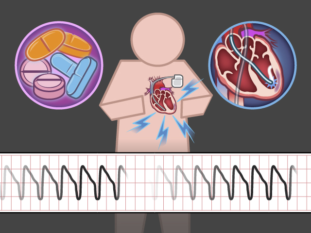 تسرع القلب البطيني: الأسباب والأعراض والتشخيص والعلاج