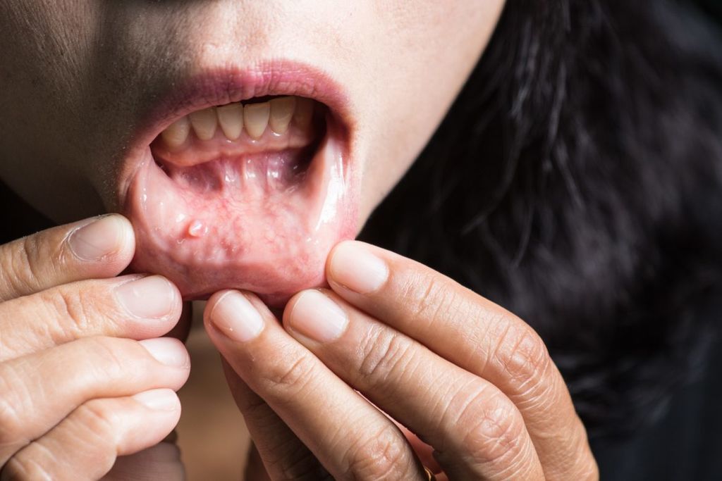 سرطان الفم: المراحل والأعراض والتشخيص