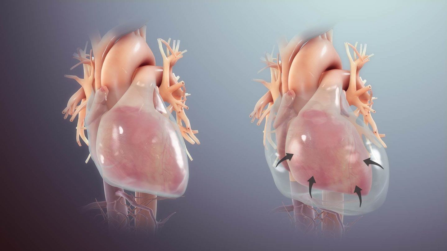 اندحاس القلب أو الدكاك القلبي cardiac tamponade