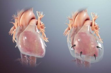 اندحاس القلب أو الدكاك القلبي cardiac tamponade الأسباب والأعراض والتشخيص والعلاج تراكم سائل حول عضلة القلب الاندحاس التاموري