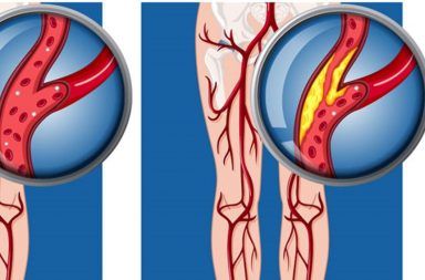 مرض الشريان المحيطي PAD: اعتلال الأوعية المحيطي مرض الأوعية الدموية الموجودة خارج القلب والمخ ترسب بعض البقايا الدهنية في الشرايين