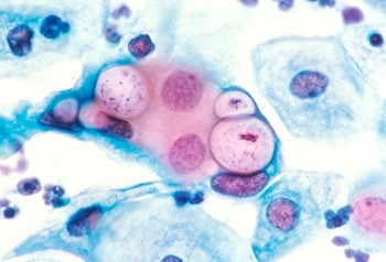 تظهر الصورة مسحة من عنق الرحم تسمى مسحة بابانيكولا PAP smear تكشف عن وجود جرثومة المتدثرة الحثرية Chlamydia trachomatis، المسببة لداء الكلاميديا، داخل الحويصلات الخلوية.