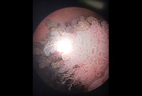 تظهر الصورة سرطان المثانة عند رجل مسن يعاني بيلة دموية عيانية غير مؤلمة منذ 4 أشهر، وكان أيضًا مدخنًا سابقًا.