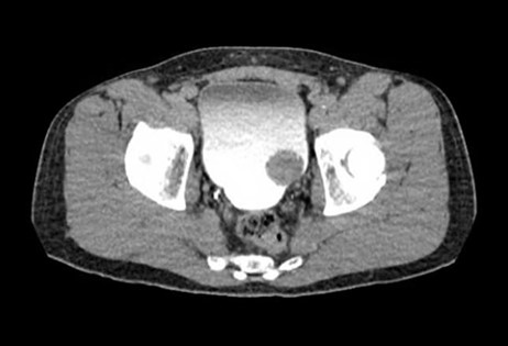 يظهر الشكل صورة مقطعية محوسبة متأخرة لذكر في منتصف العمر يعاني بيلة دموية عيانية غير مؤلمة منذ شهرين، أظهر الفحص المقطعي وجود خلل كبير في نظام التعبئة والإفراغ في المثانة يتوافق مع ورم المثانة، أظهر تنظير المثانة ورمًا كبيرًا، خضع المريض لاستئصال سرطان المثانة ووجد أنه مصاب بسرطان بمرحلة pT1 (غزو في الصفيحة المخاطية المخصوصة).