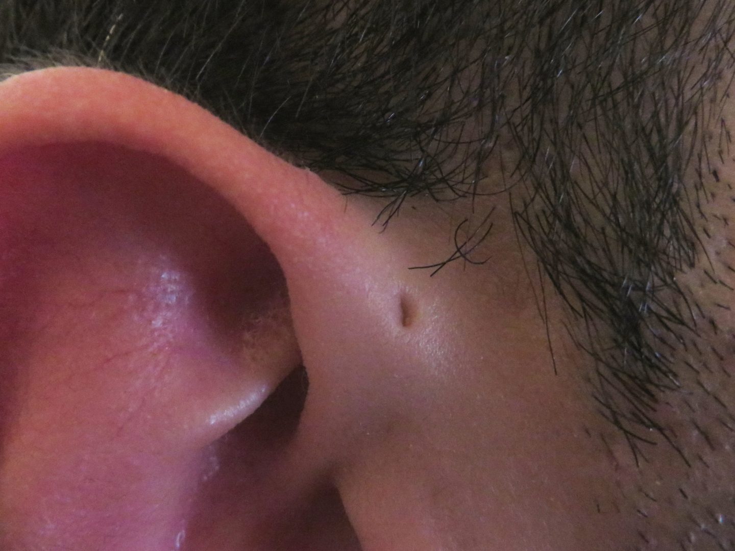 ما أسباب وجود الوهدة أو الثقب أمام الأذن؟ وهل من مخاطر؟