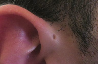 لماذا يمتلك بعض الناس يقوب في الأذن دون غيرهم؟ ما أسباب وجودها؟ هل من مخاطر ناجمة عن الثقب أمام الأذن؟ متى تجب مراجعة الطبيب؟