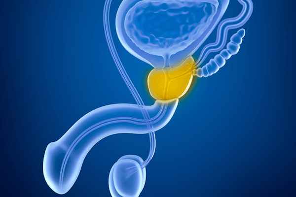 التهاب البروستات المزمن: الأسباب والأعراض والتشخيص والعلاج