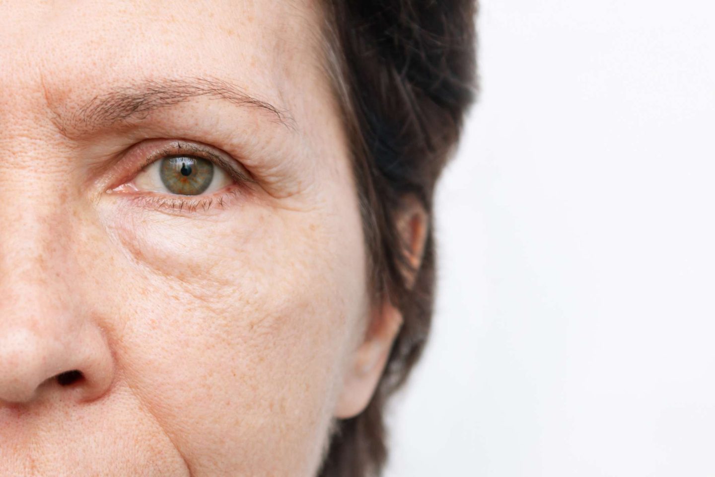 انتفاخ العين: الأسباب والأعراض والتشخيص والعلاج