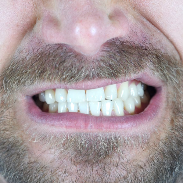 صرير الأسنان: الأسباب والعلاج