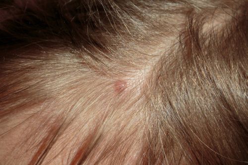 التهاب الجريبات الشعرية: الاسباب والأعراض والتشخيص والعلاج