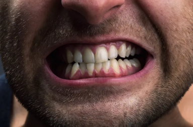 صرير الأسنان: الأسباب والعلاج - نتائج القلق والضغط النفسي - صريف الأسنان - لماذا يصر البعض بأسنانهم - العض والضغط على الأسنان