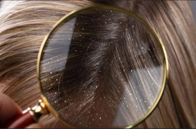 قشرة الشعر: الأسباب والعلاج - قشرة الرأس - التهاب الجلد الدهني والاستجابة التحسسية والصدفية والأكزيما - أسباب الإصابة بقشرة الشعر