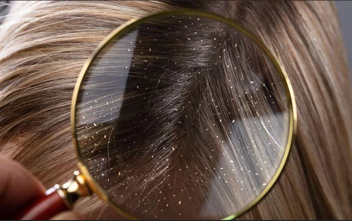 قشرة الشعر: الأسباب والعلاج