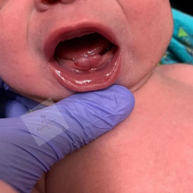 هل من الطبيعي أن يولد الطفل ولديه أسنان؟
