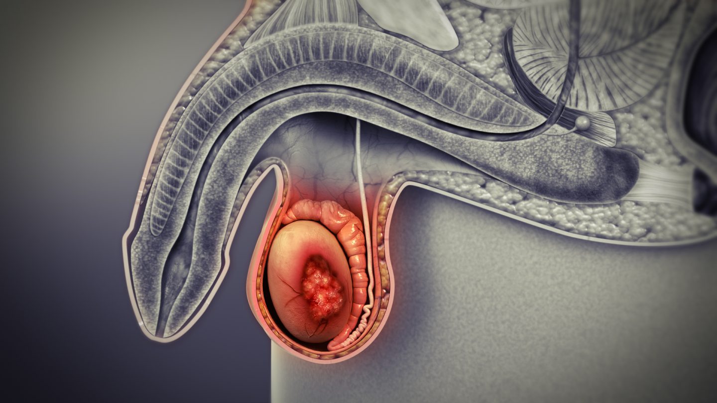 سرطان الخصية: الأسباب والأعراض والتشخيص والعلاج