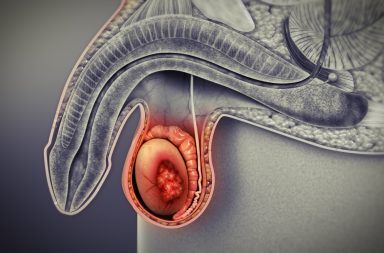 سرطان الخصية Testicular Cancer: الأسباب والأعراض والتشخيص والعلاج - كيف يتم علاج سرطان الخصيتين - سرطانات الجهاز التناسلي