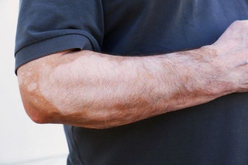 السعفة المبرقشة الأسباب الأعراض والعلاج أنا أصدق العلم