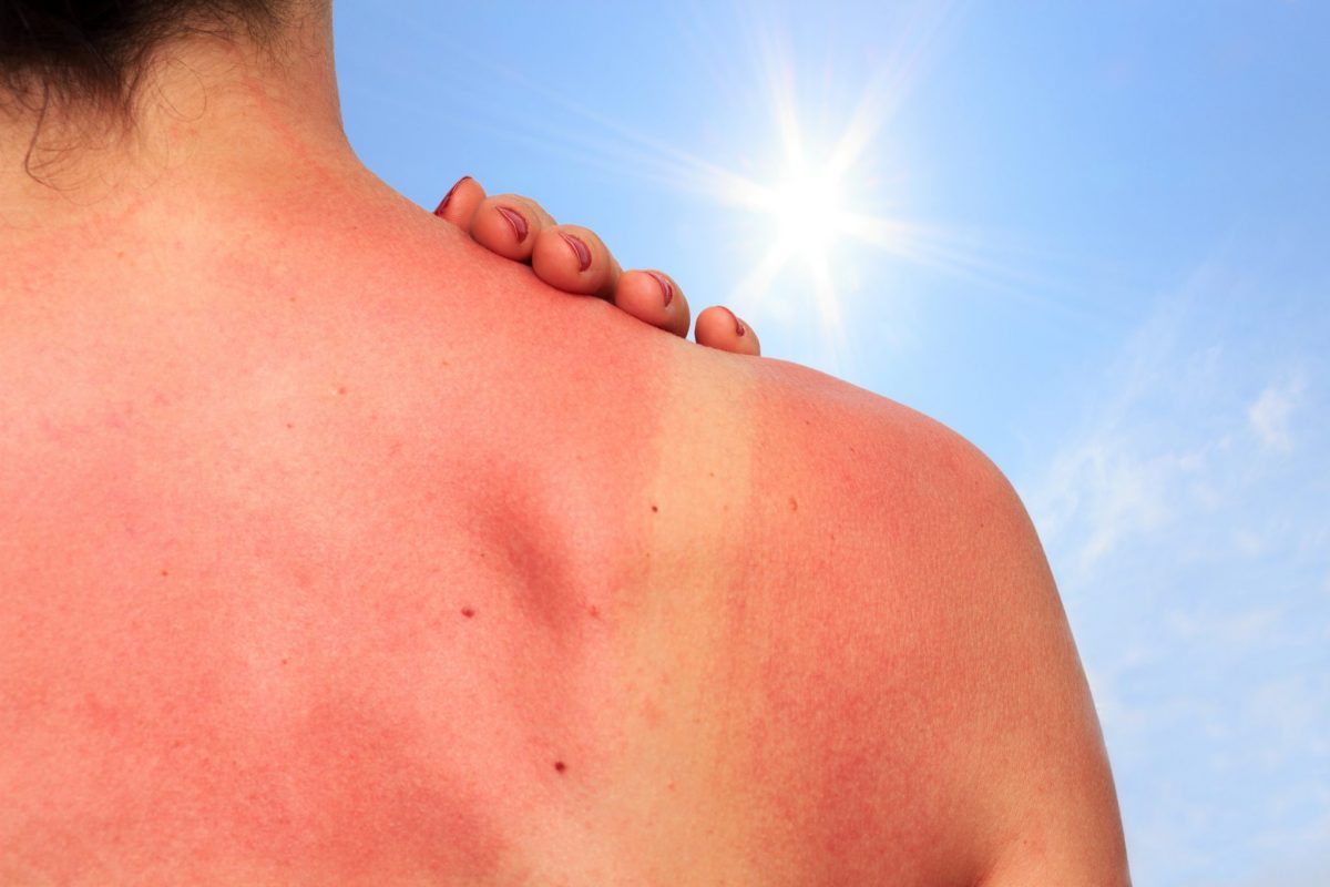 مع اقتراب فصل الصيف، كيف تقي جسمك من حروق الشمس ؟