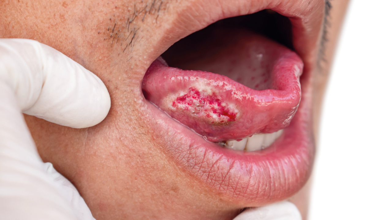 أعراض الإصابة بسرطان الفم