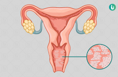 التهاب المهبل الجرثومي: الأسباب والأعراض والتشخيص والعلاج - Bacterial Vaginosis - يحتوي مهبل المرأة طبيعيًّا على أنواع مختلفة من الجراثيم