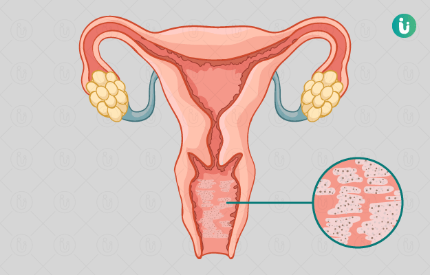 Vaginosi batterica: cause, sintomi, diagnosi e trattamento - Credo nella scienza