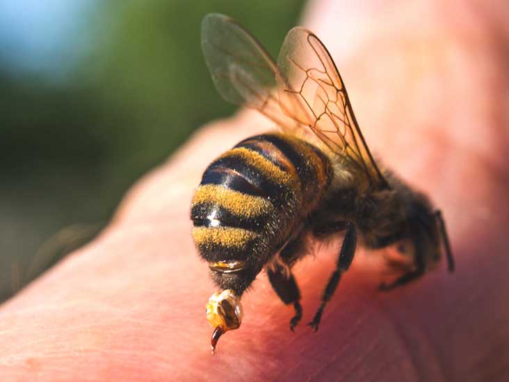 سم نحل العسل يقتل خلايا سرطان الثدي ويعزز العلاج الكيميائي