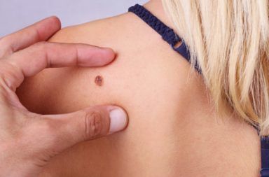 الميلانوما Melanoma – الورم الميلانيني الأسباب والأعراض والتشخيص والعلاج أكثر أنواع سرطان الجلد شيوعًا الوقاية من سرطان الجلد
