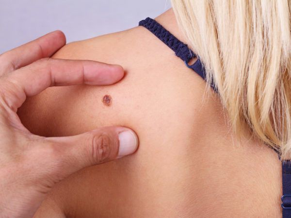 الميلانوما Melanoma – الورم الميلانيني