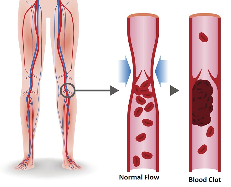 ما هي أسباب تخثر الدم وما علاجه - الخثرة الدموية - تغير هيئة الدم من الحالة السائلة إلى الهلامية أو شبه الصلبة - انسداد الأوعية الدموية