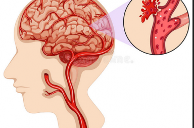 السكتة الدماغية النزفية: الأسباب والأعراض والوقاية والعلاج - كيف تحدث الجلطة الدماغية النزفية وكيف يمكن الوقاية منها - موت جزء من الدماغ