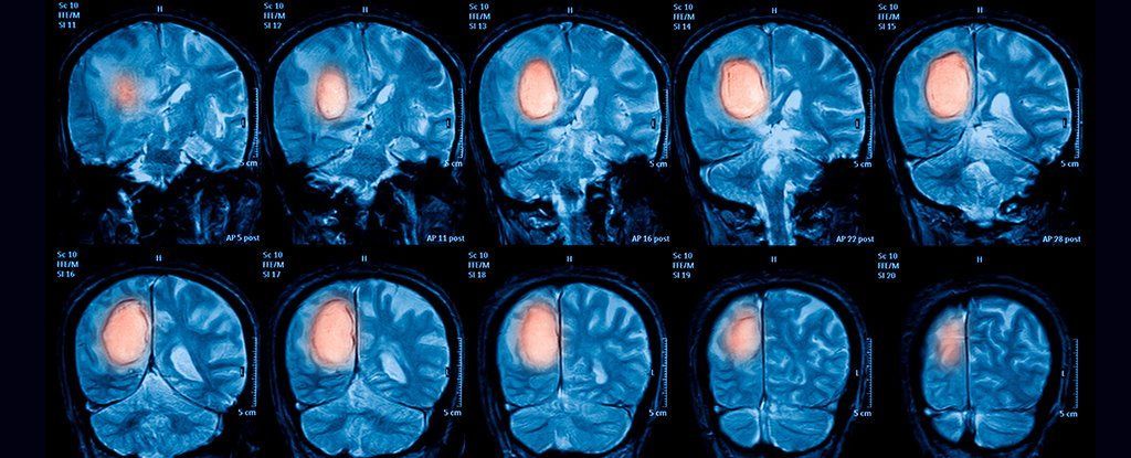 لا يوجد ارتباطٌ واضح بين سرطان الدماغ والحقول المغناطيسيّة!