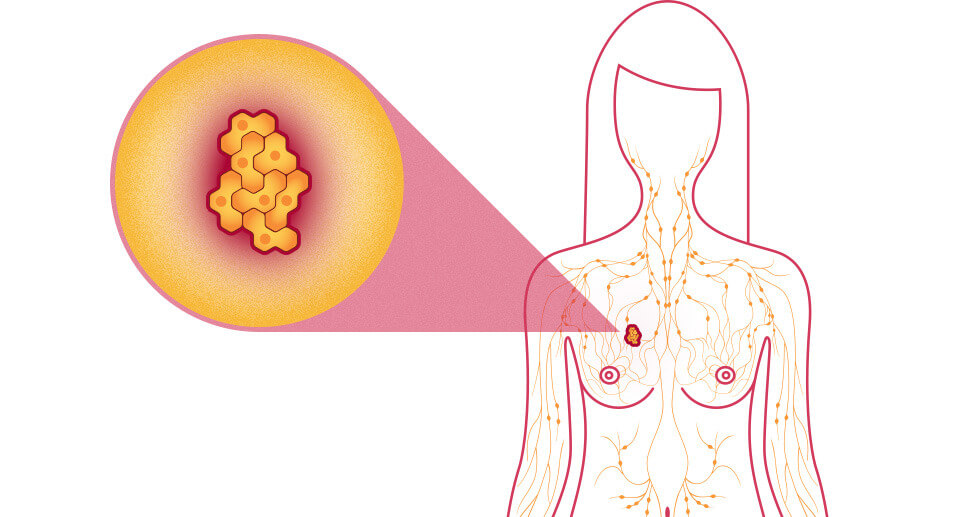 العلامات المحتملة التي تدل على سرطان الثدي عند الرجال والنساء - علامات سرطان الثدي - تصوير الثدي الشعاعي «الماموغرام» - جلدة الثدي