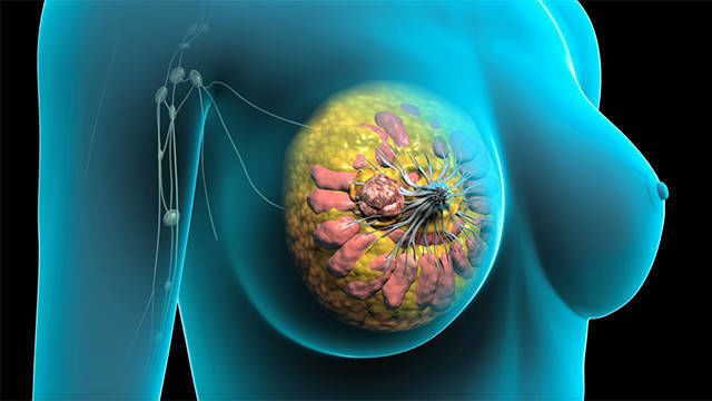 أول علاج مناعي ل سرطان الثدي !