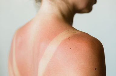 نصائح لدعم عملية شفاء الجلد وتخفيف الأعراض المصاحبة للحروق. العوامل المؤثرة في الشفاء من حروق الشمس. هل الماء الباردة تفيد في حالة حروق الشمس؟