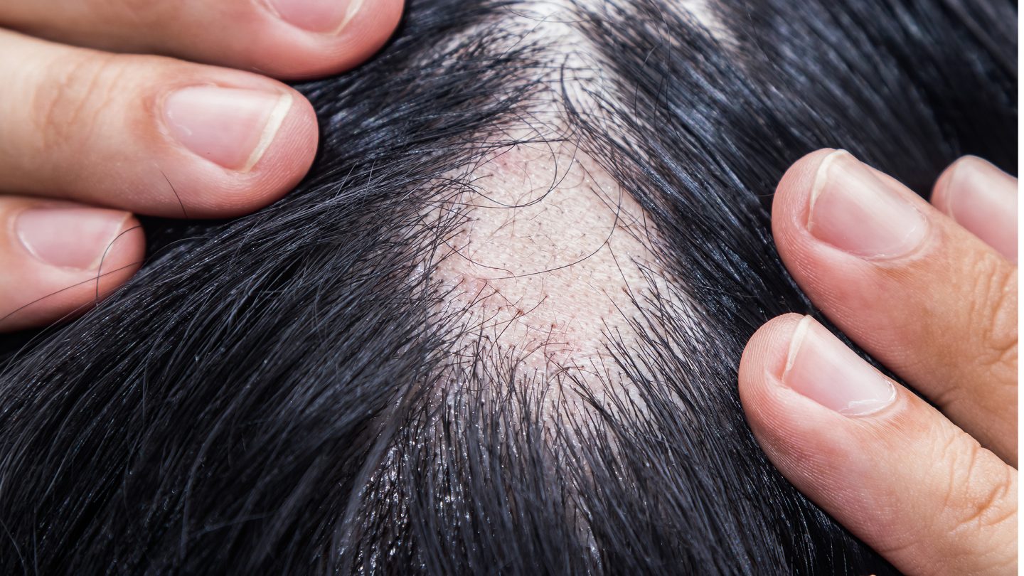 فقدان الشعر لدى النساء: الأسباب والأعراض والتشخيص والعلاج
