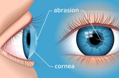 أعراض خدش القرنية علاج خدش القرنية الأسباب والأعراض والتشخيص والعلاج قرنية العين العدسات اللاصقة خدوش القرنية إصابات العين