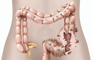 داء الرتج الأسباب والأعراض والتشخيص والعلاج بروزات صغيرة أكياس في جدار الأمعاء الغليظة القولون المستقيم الشرج التهاب الرتج