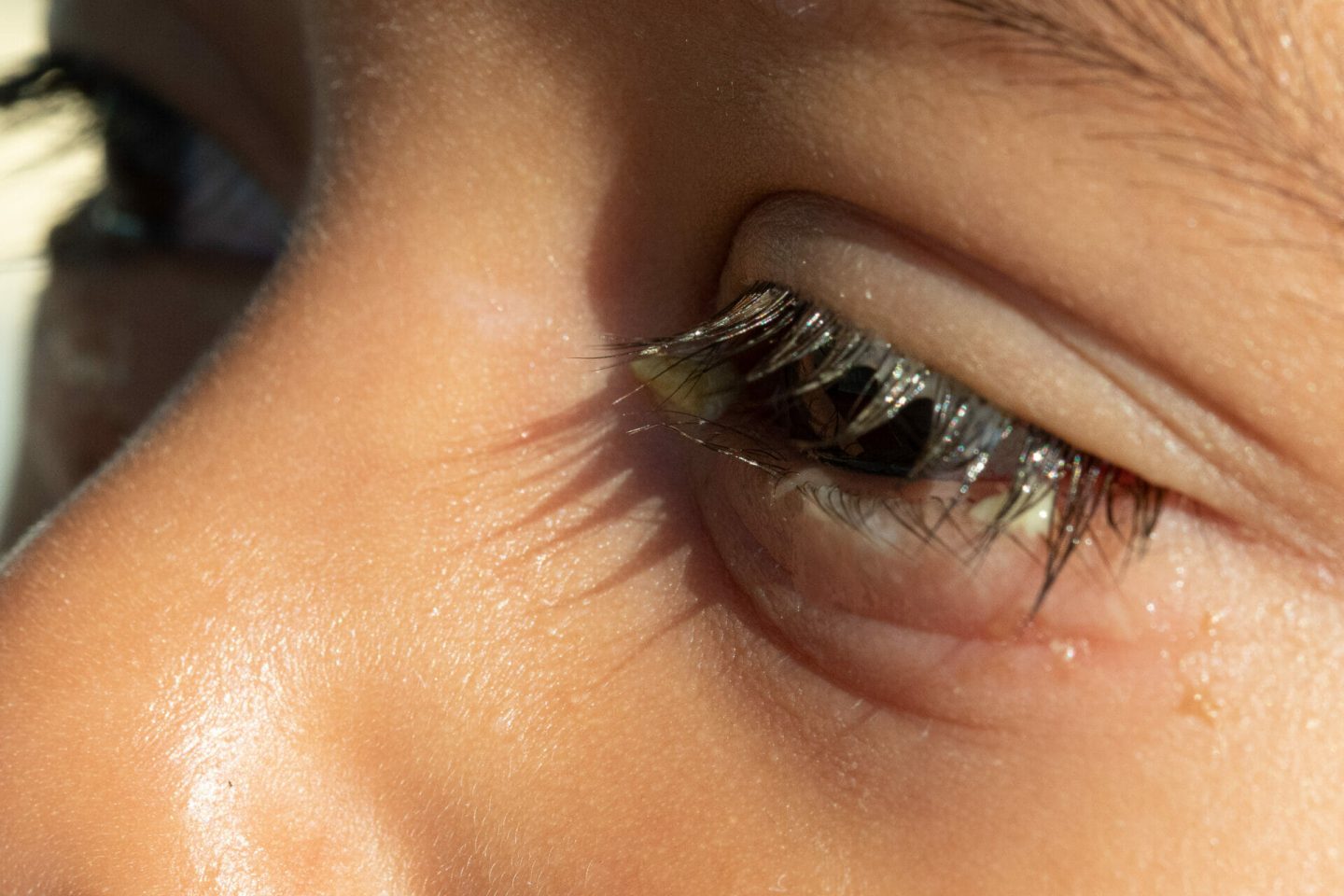 تقشر العين: الأسباب والأعراض والتشخيص والعلاج