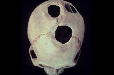 نقب الجمجمة: حين قاد الفضول البشري تطوير جراحة المخ والأعصاب - حفر ثقب في الجمجمة باستخدام أداة حادة - العصر الحجري - عمليات نقب الجمجمة