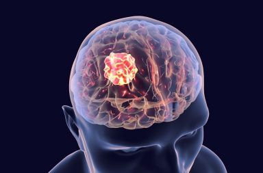 أسباب الورم النجمي أعراض الورم النجمي التشخيص العلاج الأورام الدماغية الخلايا الدبقية الخلايا العصبية أورام الدماغ الخلايا النجمية