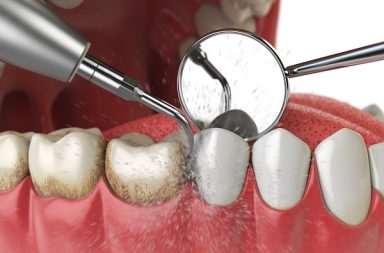 مرت عدة قرون قبل أن تصبح العناية المهنية بالأسنان متاحة على نطاق واسع. ما هي المراحل التاريخية التي مرت بها عملية تنظيف الأسنان