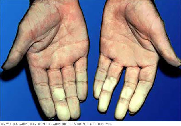 داء رينو – Raynaud’s Disease